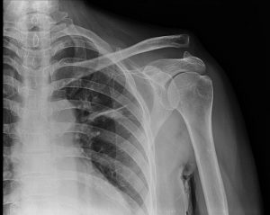 radiografie umar pret anestezie unguent dureri articulare